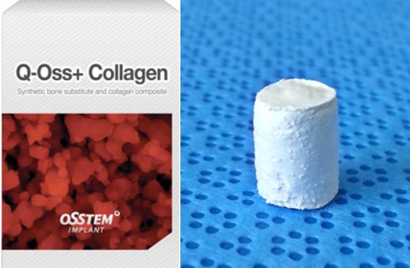 Q-Oss+ Collagen은 조형성이 우수해 치조능 증대 및 재건에 매우 탁월하다.