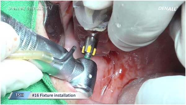 정현준 원장의 ‘Bilateral sinus graft and implantation with OneGuide System’ 편 수술장면.
