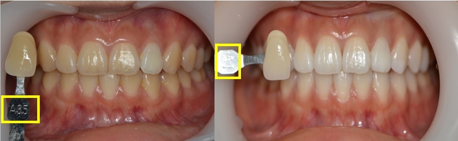 치아미백술 전과 후. A3.5에서 A1 색상으로 바뀌었다.