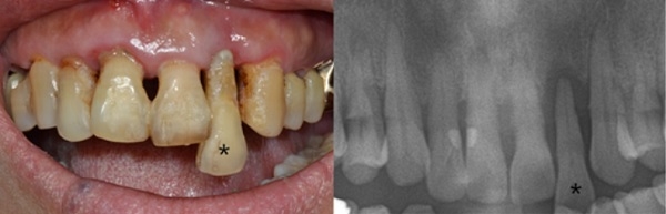 [사진1] 치주염 환자사진(잇몸이 붓고 피가 나며, 전반적인 치조골 손실과 치은 퇴축이 나타난다. *표 표시된 치아는 치조골 소실이 심하여 흘러내리는 소견을 보인다.)