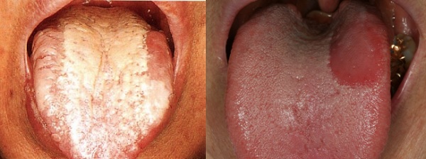 구강작열감 증상을 나타내는 구강 캔디다증(진균감염)과(왼쪽), 지도상설(지도모양의 혀) 환자 사진.