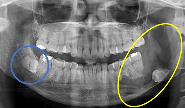 매복된 사랑니에서 발생한 함치성낭종(노란색 원)으로 치조골이 결손된 모습을 확인할 수 있다. 또한 반대편 잇몸 속에서도 매복사랑니를 확인할 수 있다.(파란색 원)