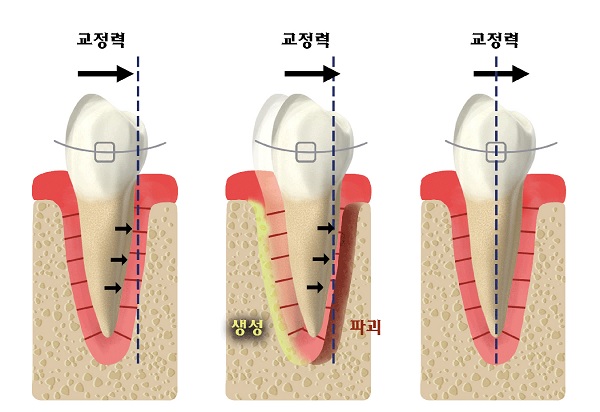 치아교정 치료에서 치아가 움직이는 원리.