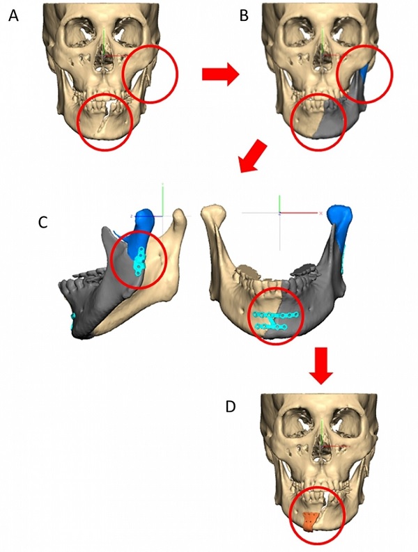 환자 맞춤형 안골절수술 모식도 ​​​​​​​(A) 환자의 CT를 3차원적으로 재구성 (B) 가상 수술로 골절편을 재위치로 정복한 모습(C) 환자 맞춤형 금속판 디자인 (D) 환자 맞춤형 수술 가이드 디자인