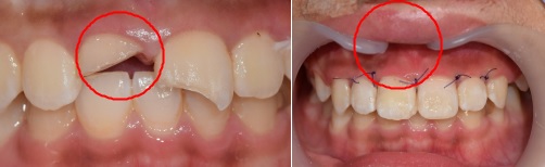 치아(치관)가 파절된 모습(좌), 치아 파절편 부착 후 모습(우).