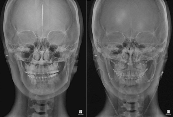 안면비대칭 수술 전(왼쪽)과 후(오른쪽) 방사선 사진.