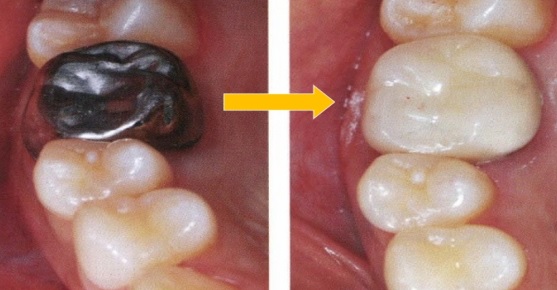 성장종료 후 스테인리스 스틸 금속 크라운을 치아 색상의 크라운으로 교체한 모습(화살표 참조)