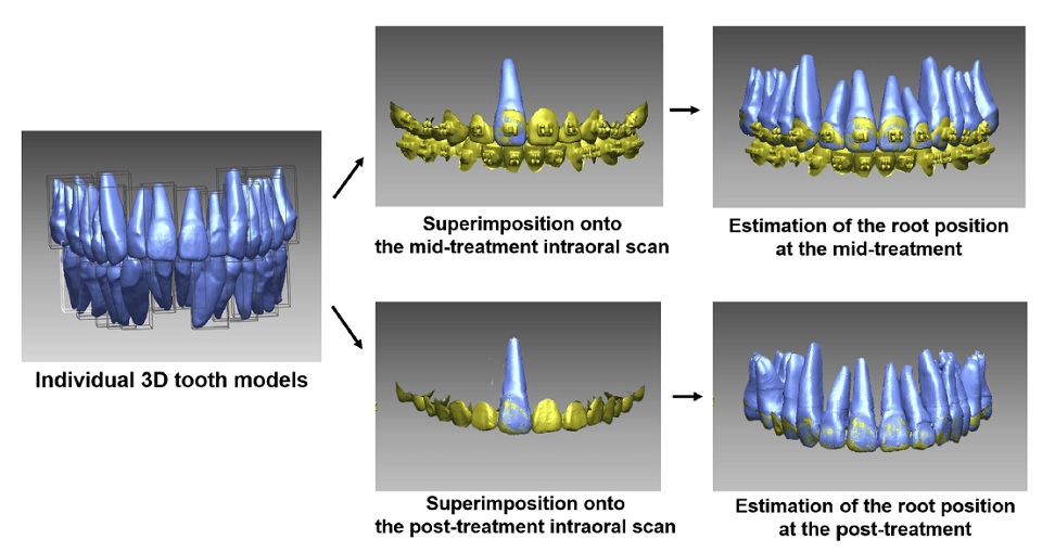 구강 스캔만으로도 치근을 포함한 3차원적 치아 이동양상 평가가 가능한 영상분석법 모식도.
